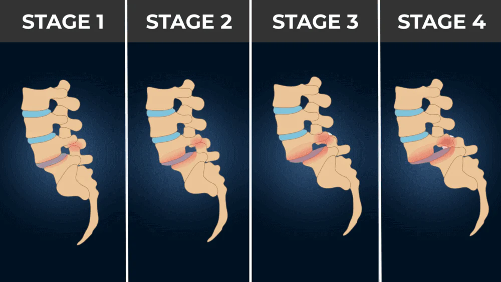 Illustration of four stages of disc degeneration, showing the space between vertebrae narrowing progressively